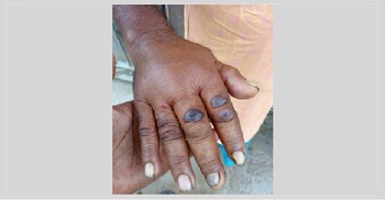 গাইবান্ধায় ৭ জনের শরীরে অ্যানথ্রাক্সের উপসর্গ