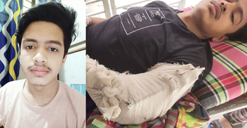 ৭ মাসেও সংগ্রহ হয়নি অপারেশনের টাকা, চোখের সামনে পচছে নাফিসের হাত