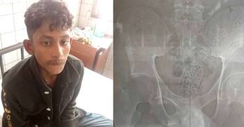 এক্স-রে করে যুবকের পেটে আড়াই হাজার ইয়াবা শনাক্ত