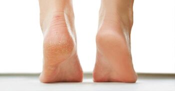 Home remedies for dry, cracked feet