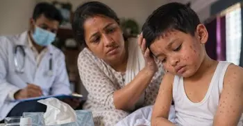 হামের প্রাদুর্ভাব: শিশুদের মানসিক বিকাশে বাড়ছে ঝুঁকি