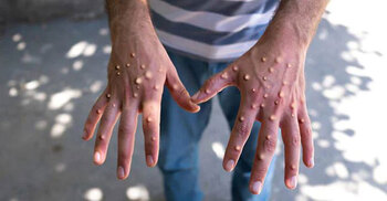 What is mpox, how it spreads, and how can it be prevented?