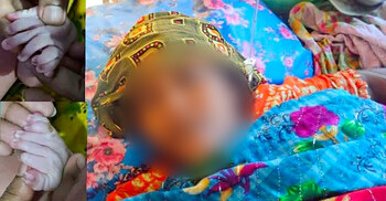 ৩০ আঙুল নিয়ে জন্ম নিলো নবজাতক, অবশেষে মৃত্যু