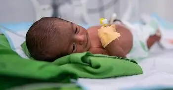 Bangladesh sees 56 preterm births every hour