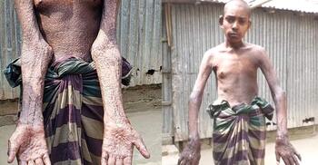 সুস্থ হতে চান বিরল রোগে আক্রান্ত মোকারাম