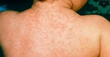 সিলেটে বাড়ছে হাম আক্রান্তের সংখ্যা, হাসপাতালে ভর্তি ২০