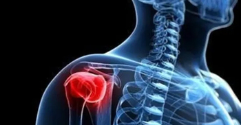 Frozen shoulder: Management and treatment options
