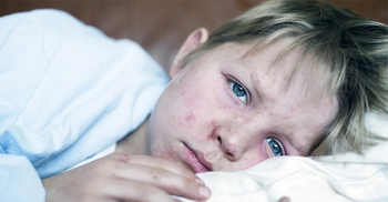 Alarming 30-fold rise in measles in Europe - WHO