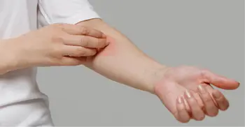 কুষ্ঠ রোগ সম্পর্কে যত ভুল ধারণা