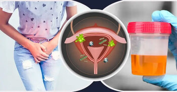 প্রস্রাবে ইনফেকশন সারানোর ঘরোয়া ৫ উপায়