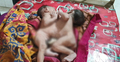 ভোলায় জন্ম হলো পেট জোড়া লাগানো যমজ শিশুর