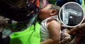 ব্রাহ্মণবাড়িয়ায় সিজারের সময় নবজাতকের হাত ভেঙে ফেলার অভিযোগ
