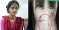 তিন ঘণ্টার অস্ত্রোপচারে পেট থেকে বের হলো সেই কাঁচি
