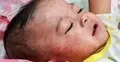 হাম হলে শিশুকে সুস্থ রাখতে মানুন এই নিয়ম