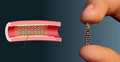 Govt revises coronary stent prices by up to Tk 47,800