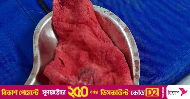 এক ফুট গজ রেখেই সেলাই, ৭ মাস পর অপারেশনে অপসারণ