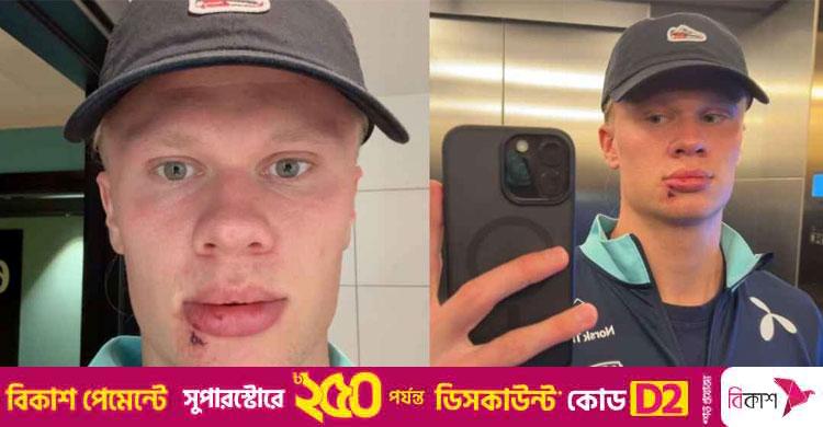 নরওয়ে দলে অদ্ভুত ঘটনায় আহত হালান্ড, সেলাই নিতে হলো মুখে